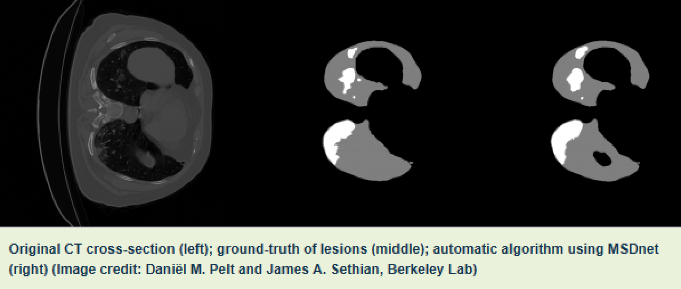 LBNL work to improve CT Scans