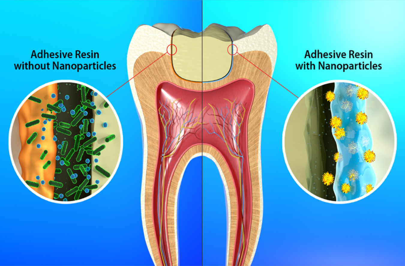 Conventional dental adhesive resins (left) can allow oral bacteria to attack and weaken the edges of a filling. Antibacterial nanoparticles in a new adhesive resin (right) can extend the life of the filling by protecting it from oral bacteria.