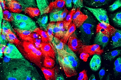 Xenograft model of prostate cancer