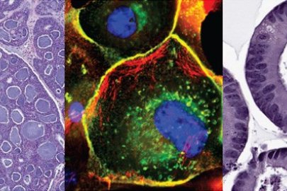 Cancer cells. Image courtesy of the NCI Patient Derived Models Repository (pdmr.cancer.gov)