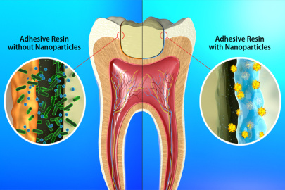 Conventional dental adhesive resins (left) can allow oral bacteria to attack and weaken the edges of a filling. Antibacterial nanoparticles in a new adhesive resin (right) can extend the life of the filling by protecting it from oral bacteria.