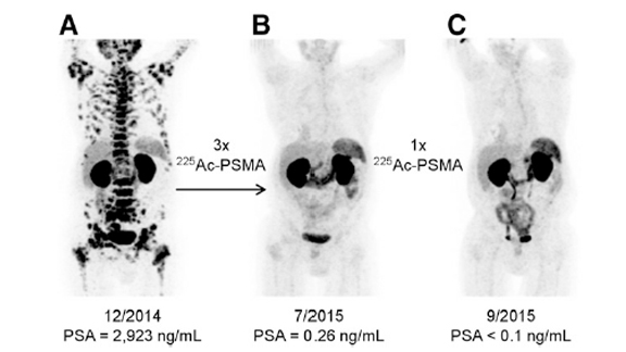 This picture shows three different images of a single patient with end-stage prostate cancer.